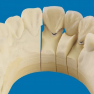 โลหะ-ฟันพอร์ซเลน